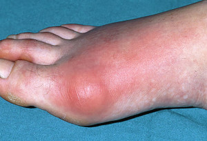 Gout is a very painful form of arthritis.  It usually starts off in just one joint, usually a big toe, an ankle or a knee.  
